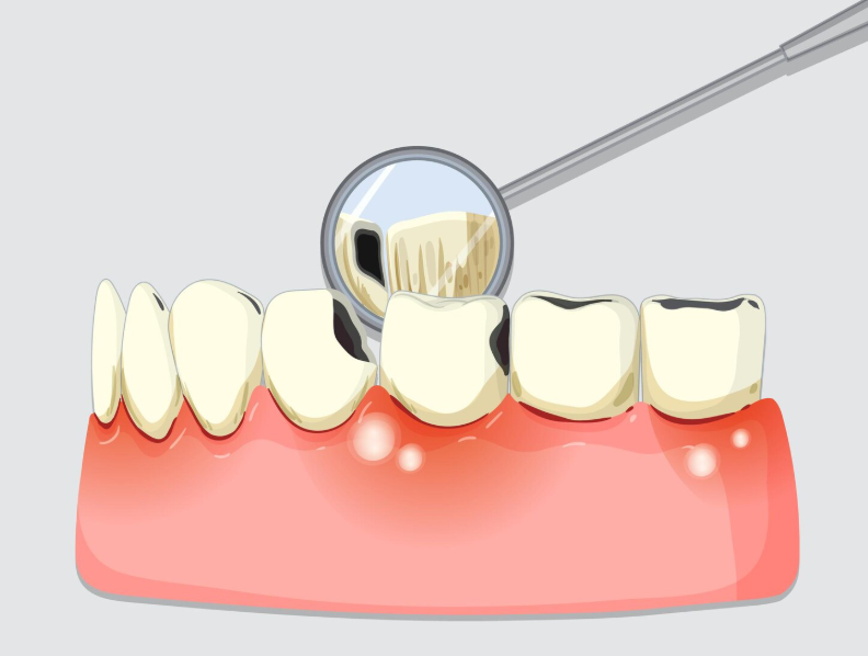 Dolgu (kompozit, amalgam vb.)