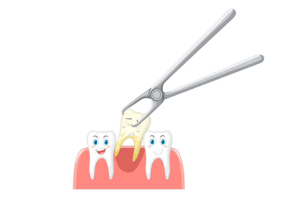 Diş Çekimi (Basit veya Cerrahi):